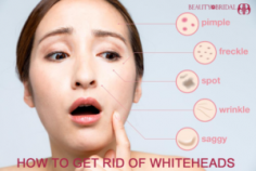 How to get rid of whiteheads on skin