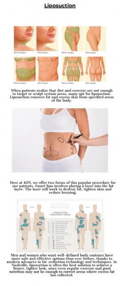 When patients realize that diet and exercise are not enough to target or sculpt certain areas, many opt for liposuction. Liposuction removes fat and excess skin from specified areas of the body.
