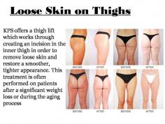 KPS offers a thigh lift which works through creating an incision in the inner thigh in order to remove loose skin and restore a smoother, tighter appearance. This treatment is often performed on patients after a significant weight loss or during the aging process.
