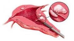 Essentially, a laparoscopic ovarian cystectomy is utilized to eliminate pimples from the ovaries.