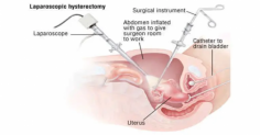 Recovery from a laparoscopic hysterectomy procedure is for the most part quick, however it’s essential to adhere to your primary care physician’s guidelines near guarantee the best results. 

