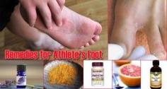 The Homestead Survival | 17 Home Remedies for Athlete’s Foot |Homesteading and Home Remedies