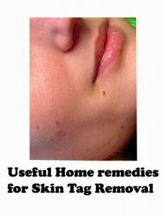 Useful Home remedies for Skin Tag Removal - Best Home Remedies