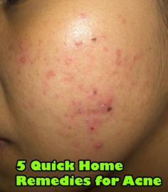 5 Quick Home Remedies for Acne - Best Home Remedies