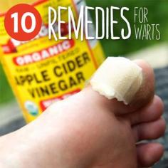 10 Home Remedies For Warts