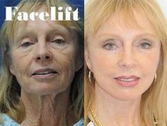 A facelift, or rhytidectomy, is a procedure in cosmetic surgery that aims to give a more youthful appearance to the face.