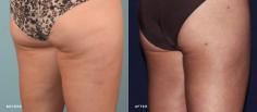 Thigh lift surgery reshapes the thighs by reducing excess skin and fat, resulting in smoother skin and better-proportioned contours of the thighs and lower body.