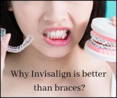 Why is Invisalign better than braces?

Smile while you still have teeth’, and this is possible until your teeth are healthy and you follow proper oral health care.