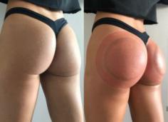 Sculptra butt lift is a cosmetic procedure that claims to enhance the curve and shape of your buttocks without surgery or a high risk of complications.